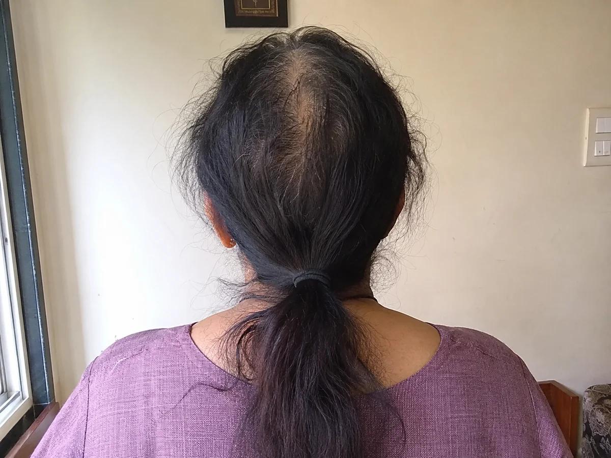 Hair before starting Mahi Herbal hair oil — thinning with a wide parting